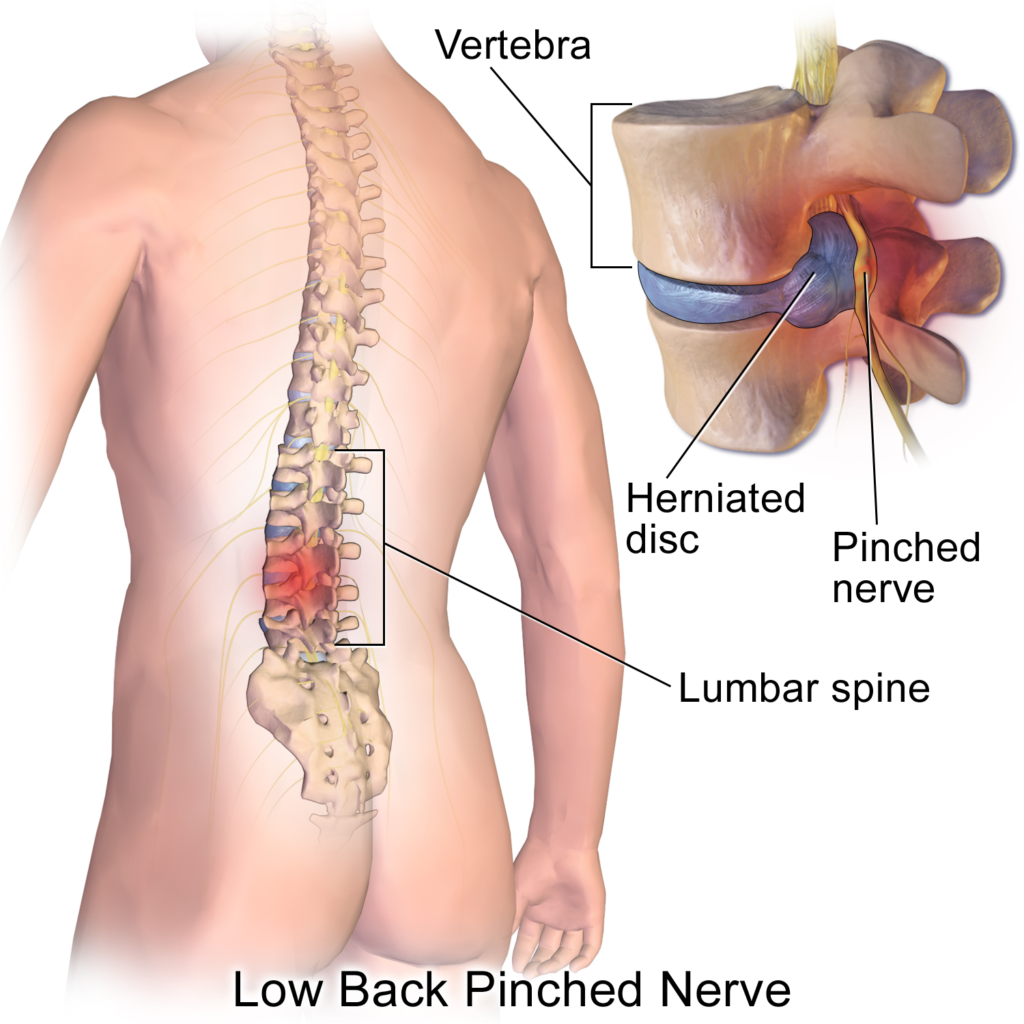 What Treatment Is There For Sciatica